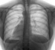 Tuberculoza coloanei vertebrale: cauze, simptome, tratament
