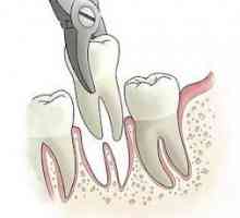 Îndepărtarea rădăcinii dintelui este o procedură complicată, dar cea mai nedureroasă