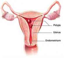 Eliminarea polipului în uter: recenzii. Perioada postoperatorie