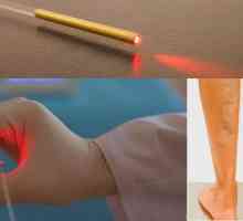 Îndepărtarea venei laser: recenzii, efecte și reabilitare