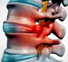 Injecții în hernia coloanei vertebrale lombare: o listă de medicamente, recomandări ale medicilor