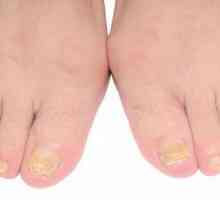 Oțet din ciuperca de unghii pe picioare: recenzii, caracteristici de aplicare și eficacitate