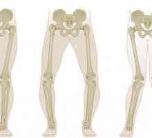 Deformarea Valgus a articulațiilor genunchiului: fotografie, cauze, tratament