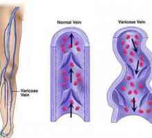 Venotonics pentru picioare varicoase: o descriere a preparatelor