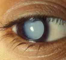 Vita-Yodourol: picături de cataractă