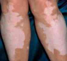 "Vitics" (gel și tablete) pentru tratamentul vitiligo: instrucțiuni de utilizare