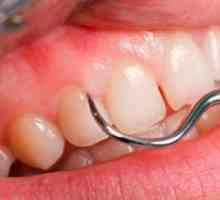 Inflamația gingiei lângă dintele de înțelepciune. Cum de a scuti gingivita la domiciliu