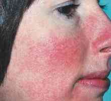 Inflamația pielii pe față: cauze, tipuri, prevenirea și tratamentul