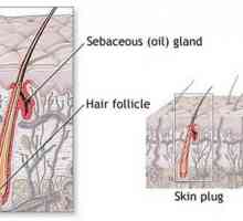 Inflamația becurilor de păr: cauze, simptome, tratament. Prevenirea inflamației becurilor de păr
