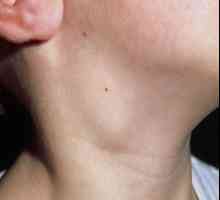 Lymphonoduses pe gât au devenit inflamate. Ce pot face pentru a ușura afecțiunea?