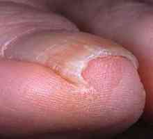 Cultivarea unghiilor: tratament și prevenire