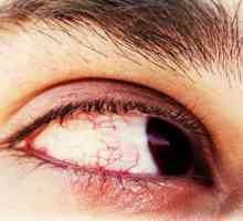 Focare în ochi: cauze, simptome