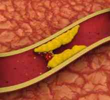 Colesterolul ridicat - o amenințare la adresa vieții