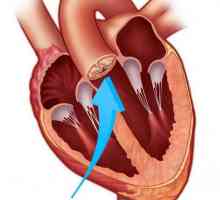 Înlocuirea valvei aortice: intervenții chirurgicale, posibile complicații, recenzii