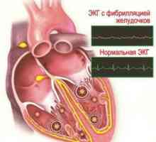 Aritmia ventriculară a inimii: simptome și tratament
