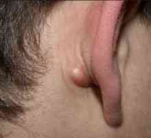 Zhirovik în spatele urechii: cauze posibile ale apariției și particularităților tratamentului