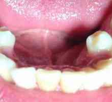 Supercomplex dinte: cauze, simptome și trăsături de tratament
