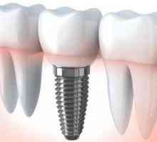 Coroană dentară pentru implant: finețea instalației
