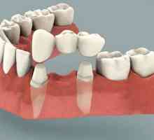 Podul de dinți: recenzii. Instalarea punților dentare