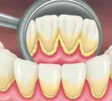 Depozite de dinți: tipuri, cauze și metode de eliminare