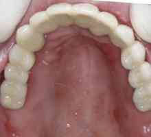 Dentures`Akri-Free: descriere, avantaje și dezavantaje, recenzii ale dentiștilor