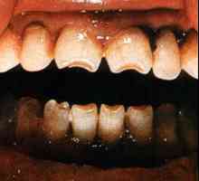 Dinții lui Getschinson: cauze, descrierea formei și structurii, fotografie