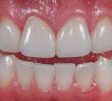 Teeth ceramic: descriere, caracteristici, fabricație și recenzii