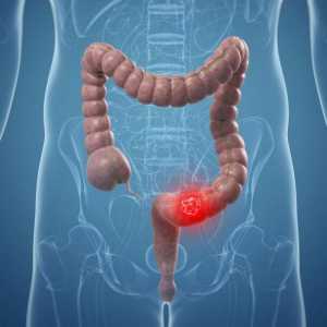 Sigmoid adenocarcinomul de colon: cauze, simptome, metode de tratament și predicții