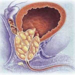 Ce este adenomul de prostată? Hiperplazia prostatică benignă
