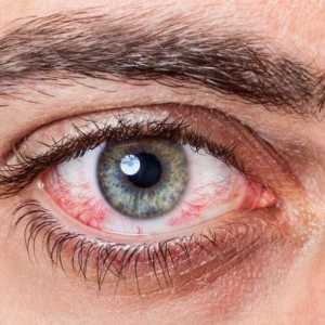Alergie la ochi: cum să tratezi, modalități eficiente și recomandări