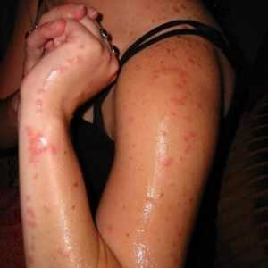 Alergia la mușcăturile de țânțari - simptome și tratament