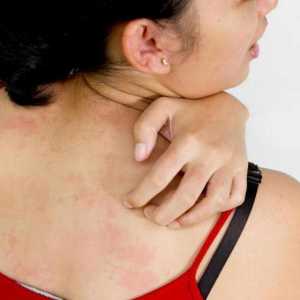 Alergia la roșii: cauze, simptome, diagnostic și tratament