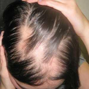 Alopecia este ceea ce este o boală? Cauze, simptome, tratamentul alopeciei