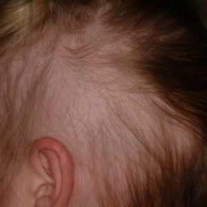 Alopecia la copii: cauze și tratament. Alopecia focală și totală la copii
