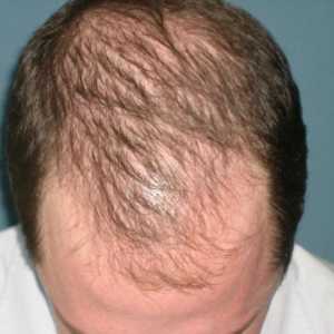 Ampulele de la căderea părului - care sunt și cum se aplică