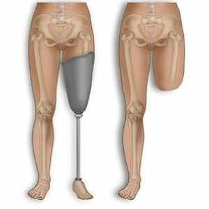 Amputarea picioarelor: reabilitare, consecințe posibile