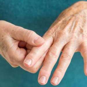 Analiza ACPC în artrita reumatoidă: normă, decodare