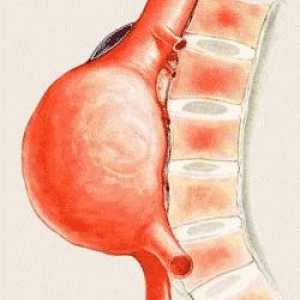 Anevrismul aortei cavității abdominale: cauze, simptome și tratament