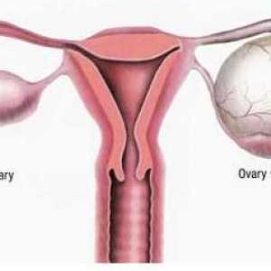 Formarea anemogenă în ovar. Ce este? Metode de tratament