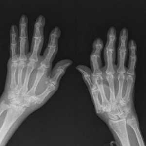 Artroza mâinilor: tratament, simptome și cauze