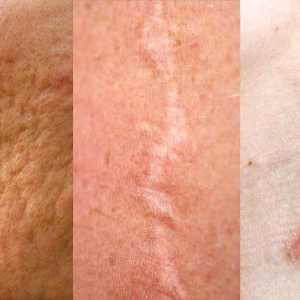 Cicatriile atrofice: cauzele apariției, tratamentului