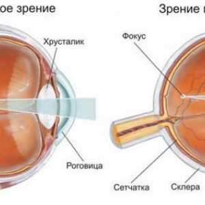 Lipsa de vizibilitate este un "plus" sau un "minus"? Operație oculară: miopie