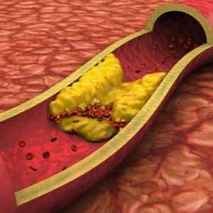 Plachetele din artera carotidă: tratament. Plachete de colesterol: cauze, simptome