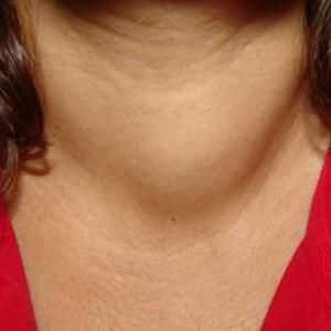 Pacientul tiroidian: tratament, cauze, simptome