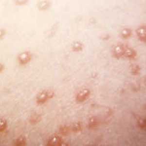 Care este tratamentul pentru varicela la copii în Rusia și în străinătate?