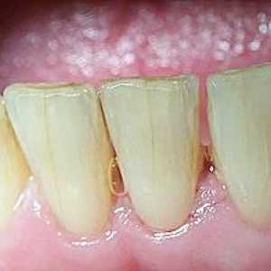 Ce se întâmplă dacă există fisuri în dinți? Cauze și tratament