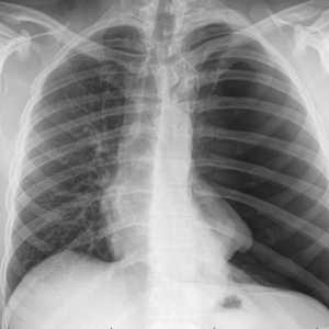 Ce arată radiografia? Interpretarea competentă a radiografiei plămânilor
