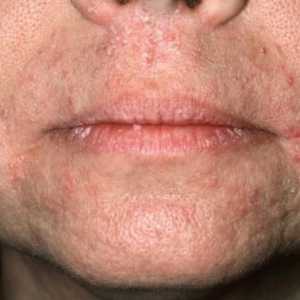 Ce este dermatita orală?