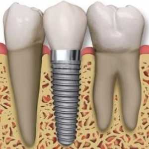 Ce recomandă stomatologii atunci când este nevoie să introduceți dinți?