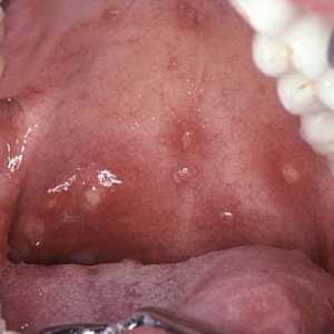 Ce este herpesul în gât la copii? Dar pentru a trata o infecție?
